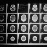 organic brain damage