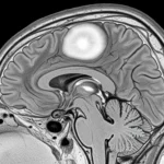 Meningioma Brain Tumor