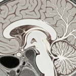 White Matter in brain