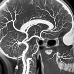 Brain Angiography