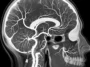 Brain Angiography